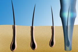 FUE extraction for hair transplantation with choi implanter pen