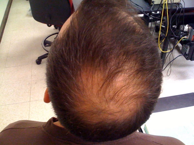 top view of a man with androgenetic alopecia on his head