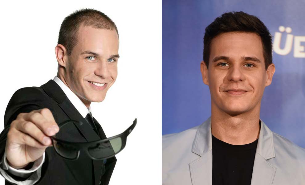 celebrity hair transplant before and after