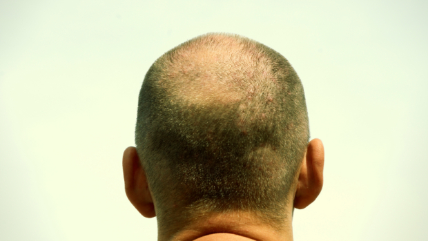 baldness