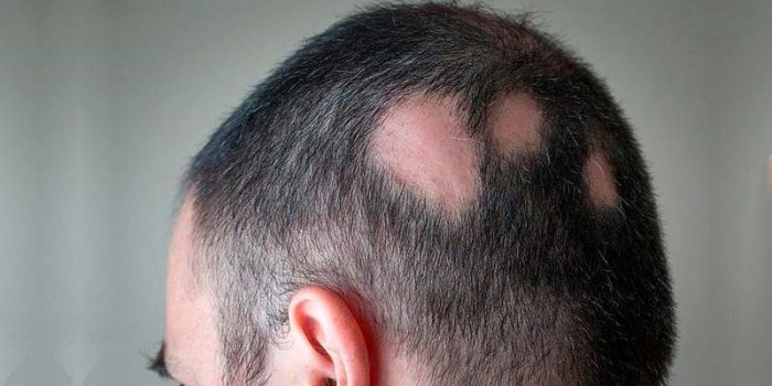 a man with scarring alopecia that leads to baldness
