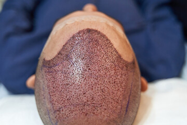 a man's inflammated scalp after a hair transplant