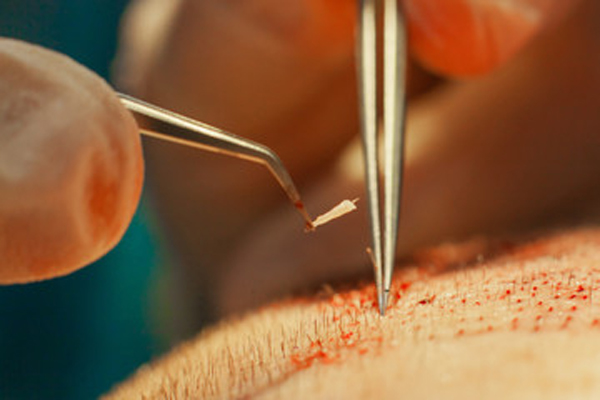 Follicular extraction of the donor area