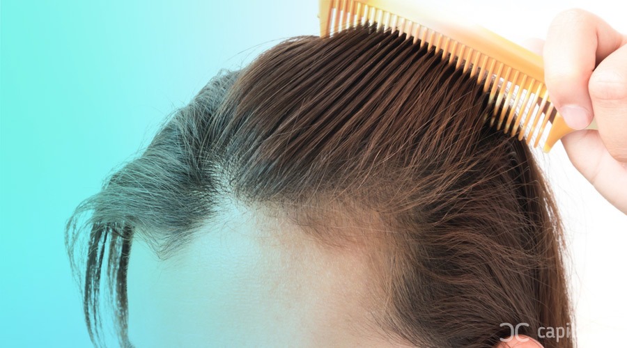 a woman showing her female alopecia
