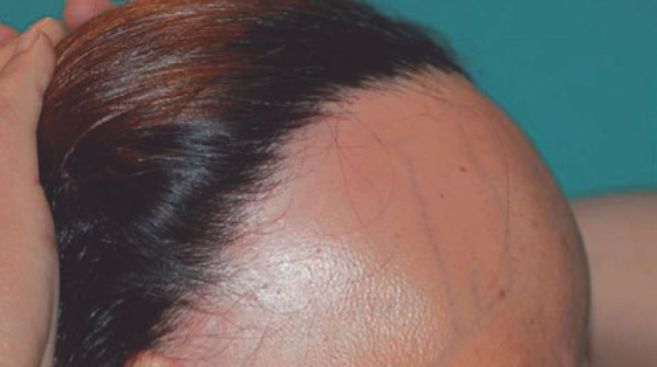 hair loss