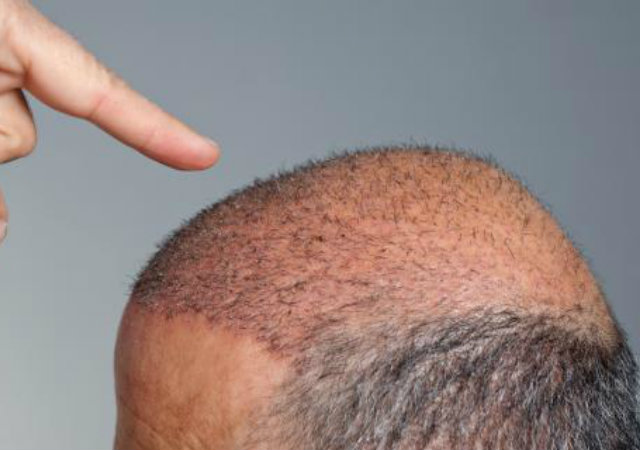 a hand pointing a bald head full of graft
