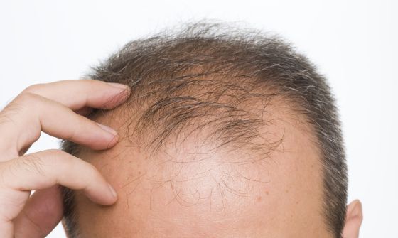 avoid hair loss