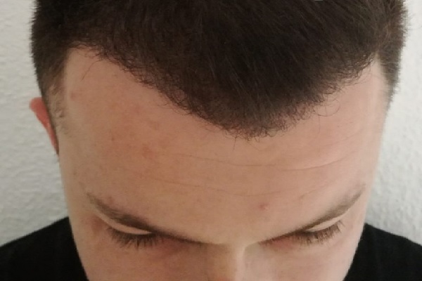 Evolution Of The Hair Transplant six months