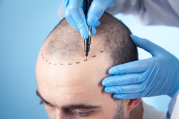 a doctor marking the hair follicles to perform a choi implanter pen