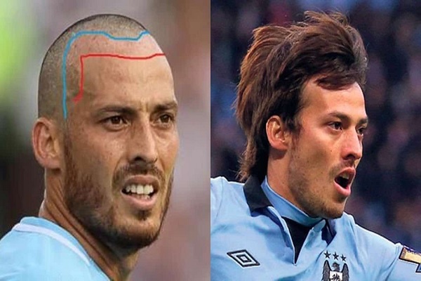 hair transplant david silva