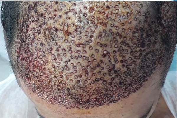 infected hair transplant - Myths and truths of hair transplant