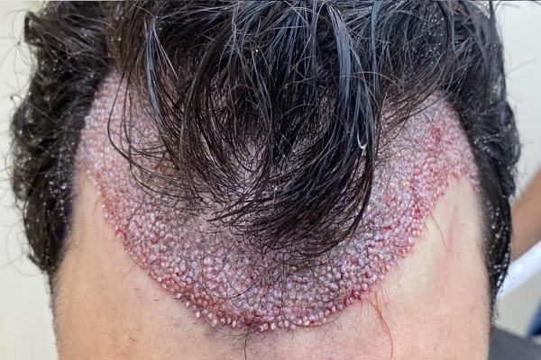 allergic reaction is one of the true Myths and truths of hair transplant