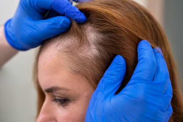 a woman with higher Density in the Hair after hair transplant with Choi Implanter Pen