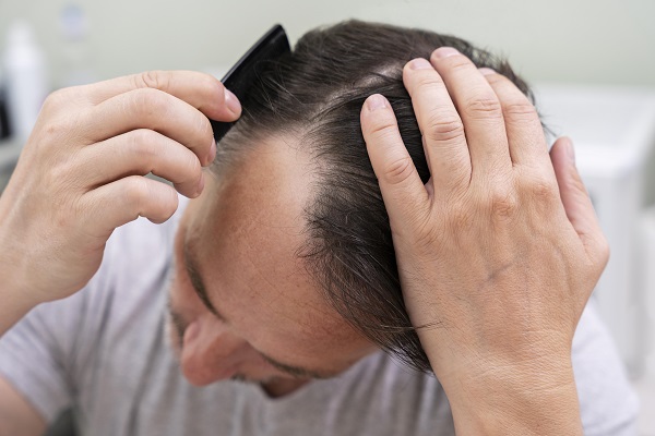 Hair Loss Caused by Covid