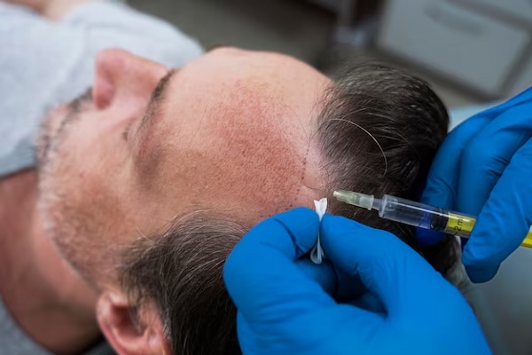 Mesotherapy for Hair: What Is It and How Does It Work?