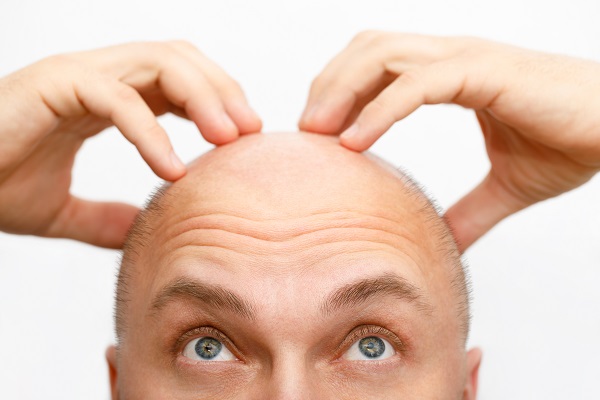 Alternatives To Hair Transplant