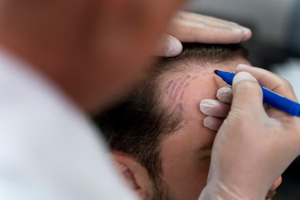 man before hair transplant surgery