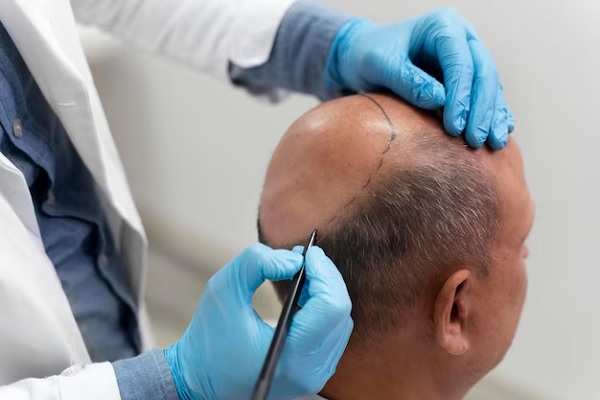 Causes of baldness on the crown