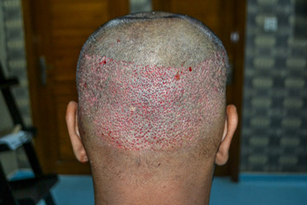 donor area of patient in a hair transplant