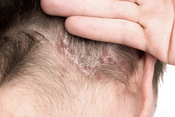 The Origins of Psoriasis