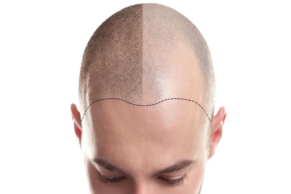 capillary tricopigmentation