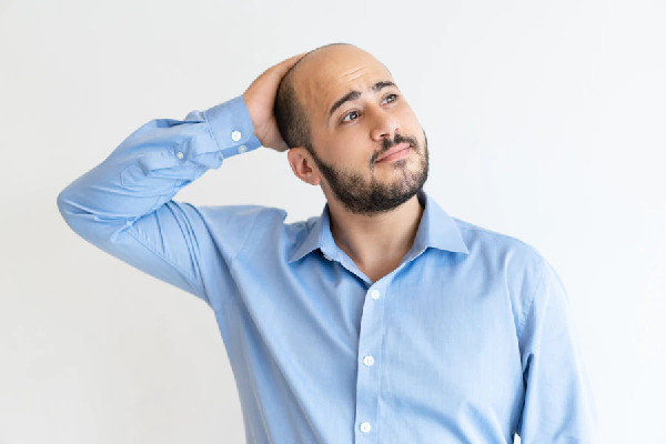 bald man before hair transaplant touching his head while looking to the side