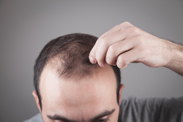 Hair Loss