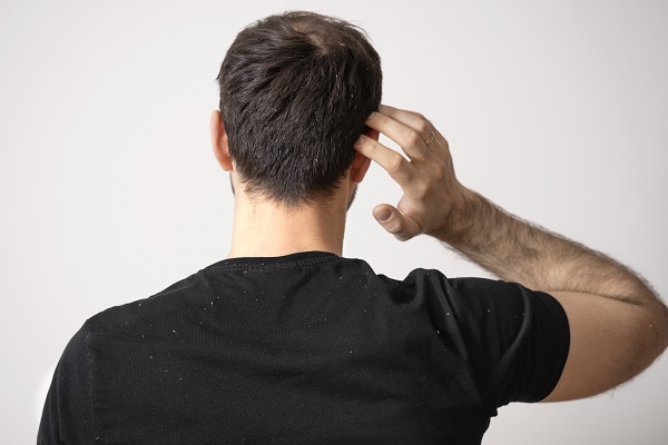How To Treat Dandruff in Men?