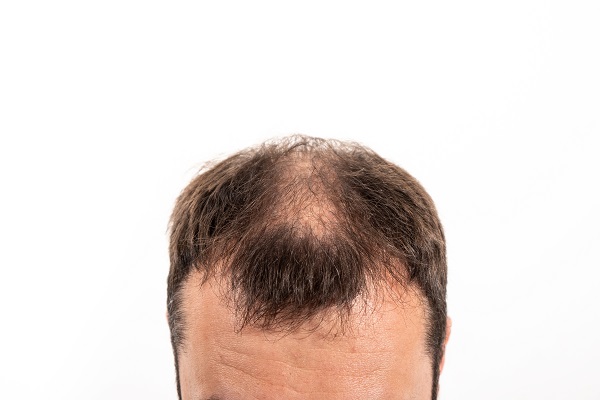 Hair Loss