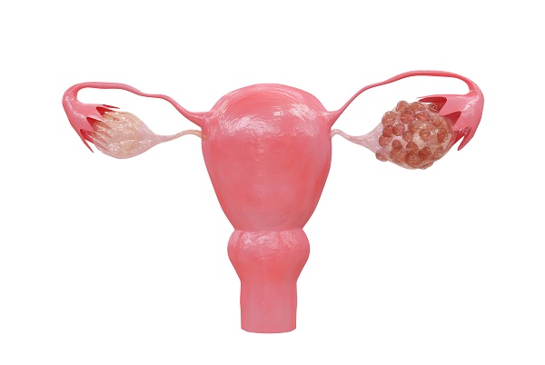 Are Polycystic Ovary Syndrome and Hair Loss Related?