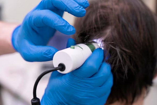 Hair Laser Therapy for stop alopecia areata from spreading