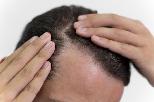 a man showing his head line with alopecia