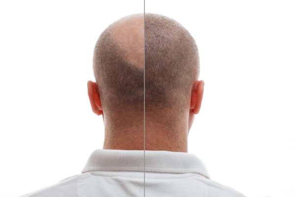 hair transplant before and after