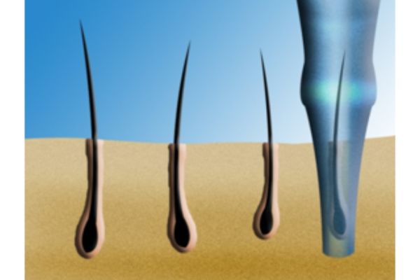 FUE extraction for hair transplantation with choi implanter pen
