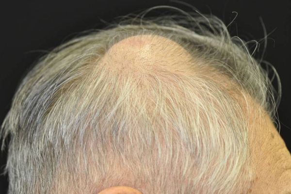 Dermoid cysts