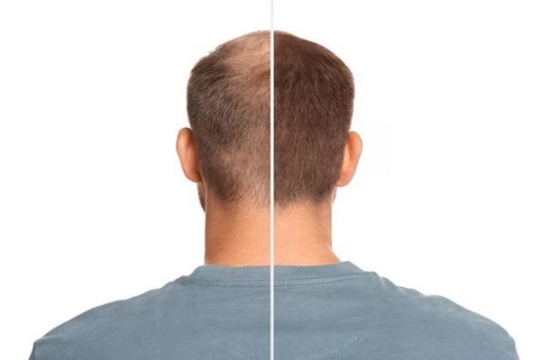 before and after hair transplant in man