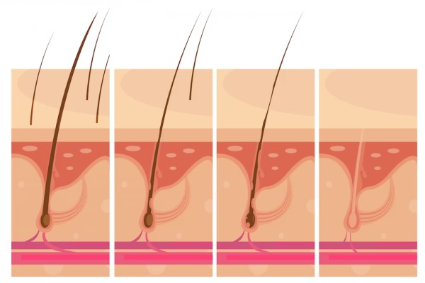 Folliculitis Decalvans