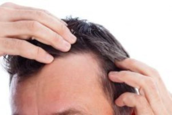 a man pointing to the Receding hairlines on his forehead