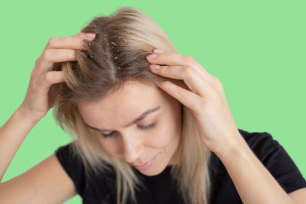 A woman with long blond hair, with dandruff due to seborrheic dermatitis