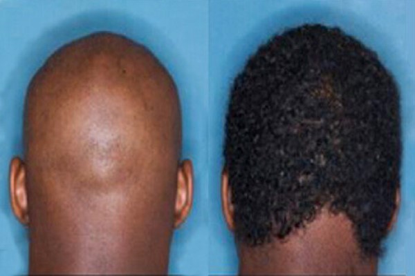 Image of JAK Inhibitors for Alopecia Areata: How They Work