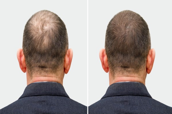 Postoperative period of hair transplantation
