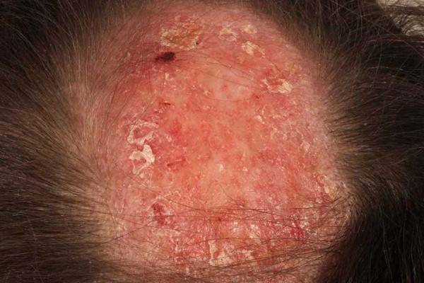 Scarring Alopecia