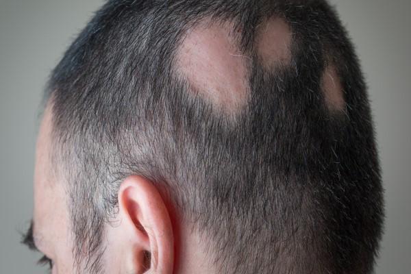 Stop Alopecia Areata from Spreading