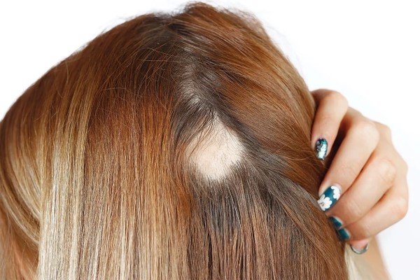 Stop Alopecia Areata from Spreading