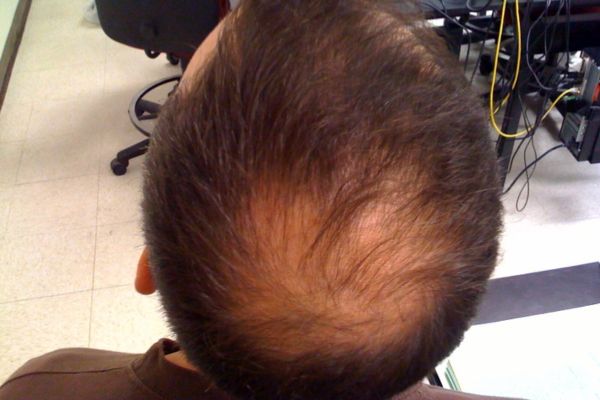 top view of a man with androgenetic alopecia on his head