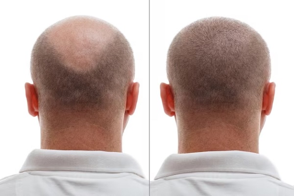 hair transplant in areas with burns