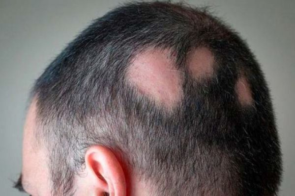 a man with scarring alopecia and patches in his back head