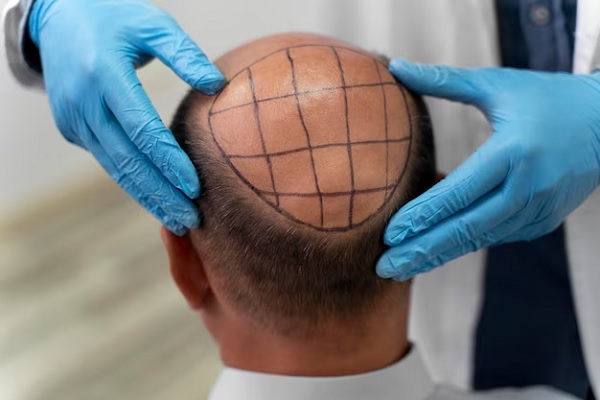 Candidate for hair transplant