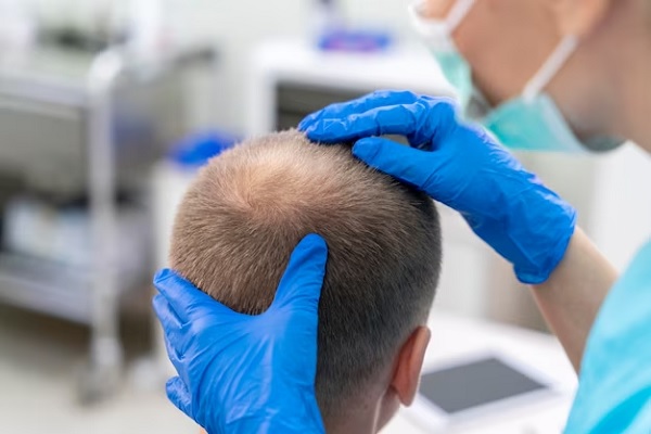Candidate for hair transplant