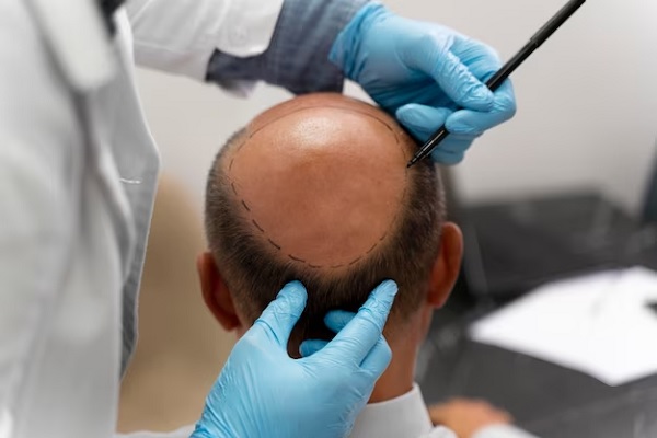 Myths and Truths of Hair Transplant